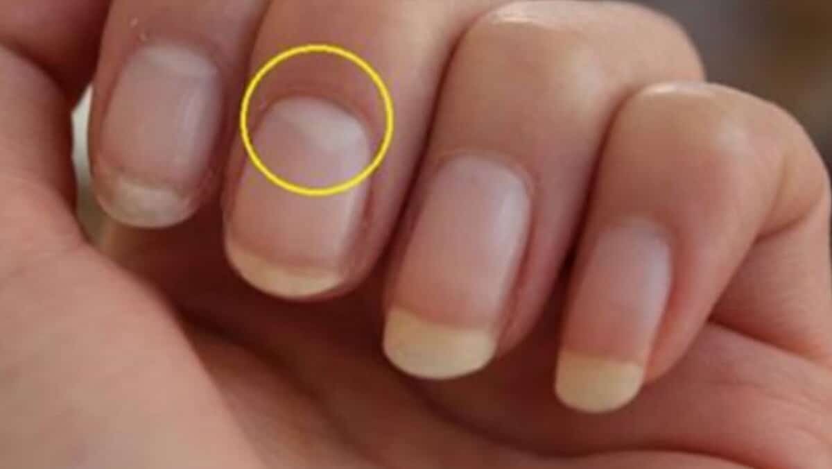 Was bedeutet eine Vertiefung im Nagel? Die Form der Vertiefung sagt viel über unsere Gesundheit aus
